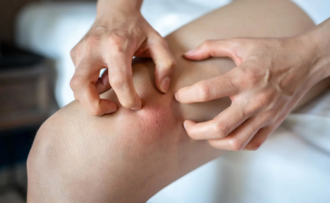 Krätze, eine alte Krankheit ist zurück: Woher kommt sie und wie wird man sie wieder los?